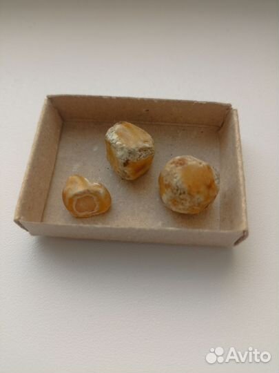 Камни из желчного пузыря человека