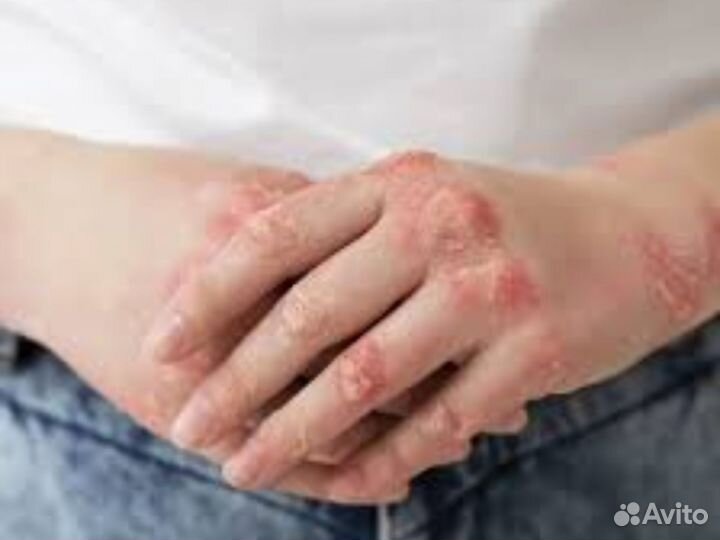 От псориаза