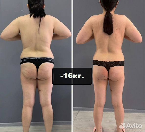 Антицеллюлитный массаж. LPG массаж. Похудение