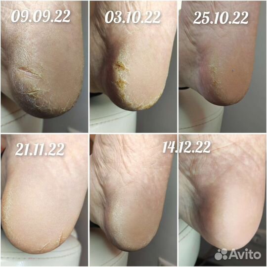 Подолог. Работа со сложными стопами