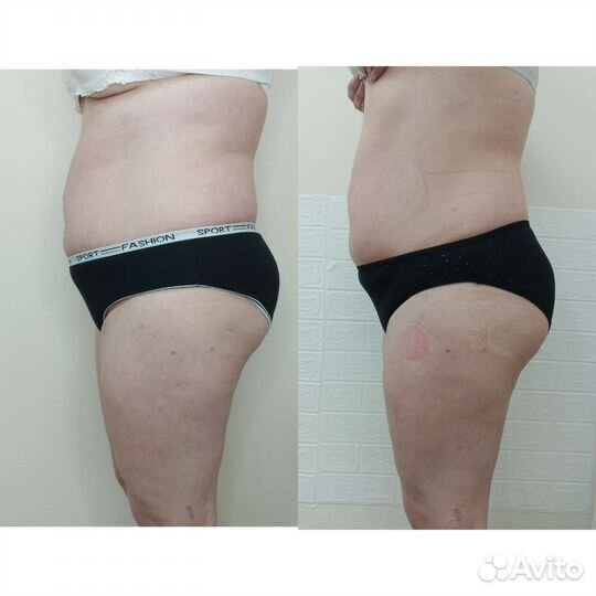 Аппаратный массаж/Коррекция фигуры