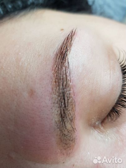 Удаление татуажа