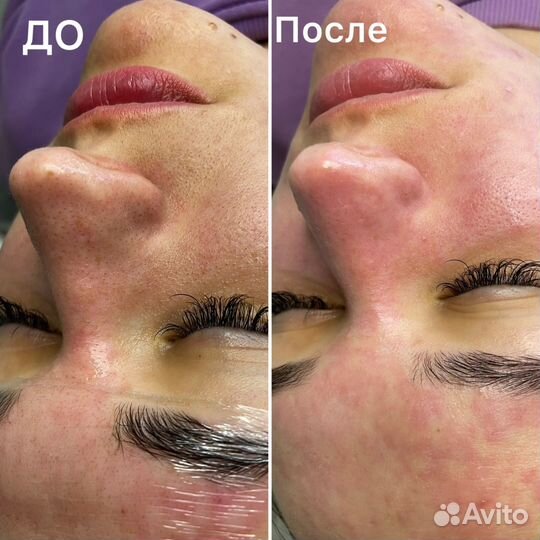 Косметолог чистка лица