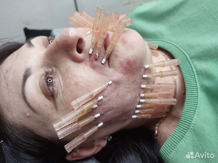 Увеличение губ топовые техники