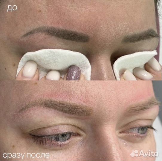 Лазер для удаления татуажа и татуировок