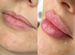 Обучение косметологии / контурной пластике губ