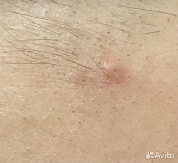 Электроэпиляция