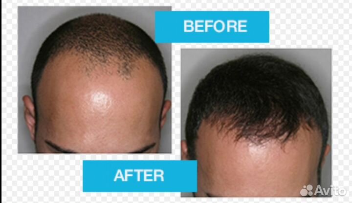 Миноксидил для бороды 3 флакона + пипеткаСвежайший