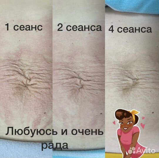 Массаж антицеллюлитный