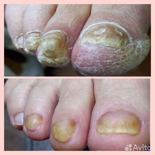 Педикюр любой сложности