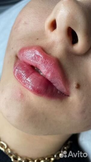 Увеличение губ. Профиль Джоли. Косметология