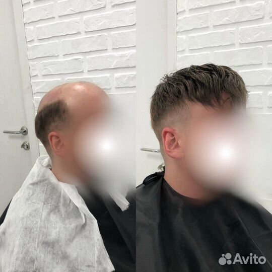 Мужская система волос, 