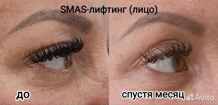 Кавитация, смас-лифтинг, RF- лифтинг, биофотон