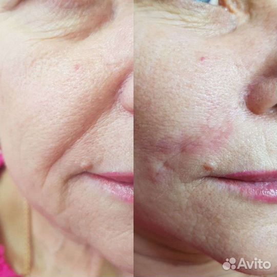 Коррекция носогубных морщин