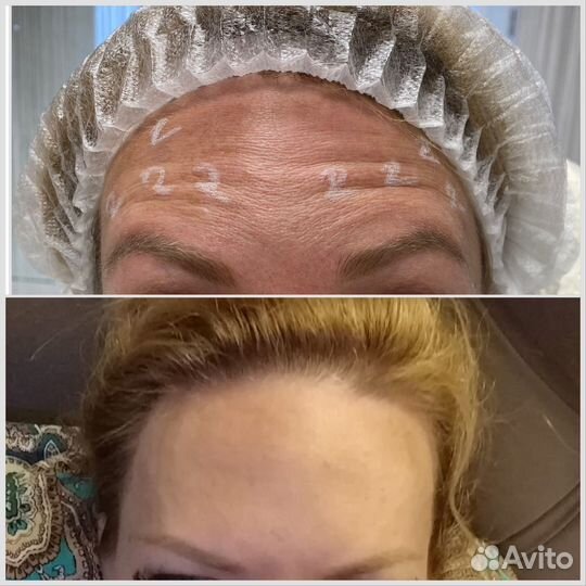 Ботокс.Устранение морщин