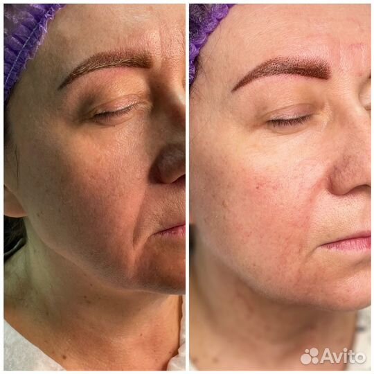 Аппаратное омоложение