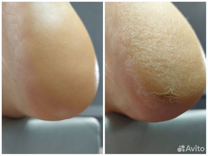 Педикюр(Smart)