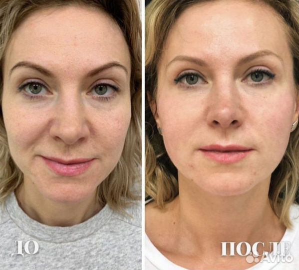 Королевский лифтинг 