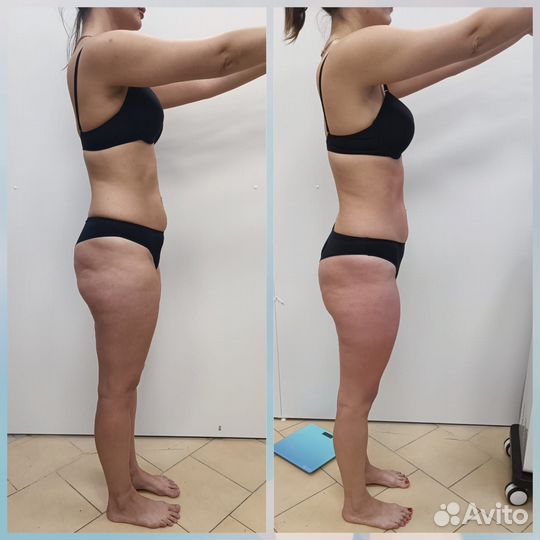 Массаж LPG(Аппаратный)