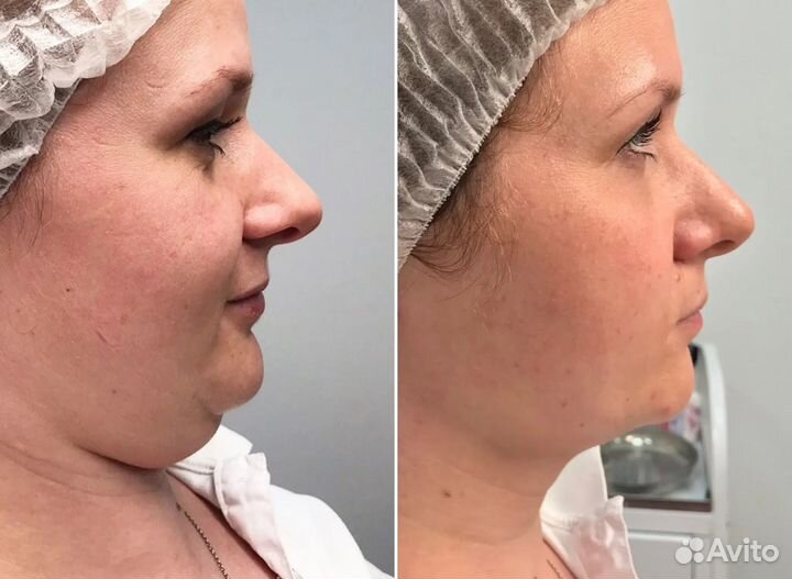 Модели на Смас лифтинг Подбородка