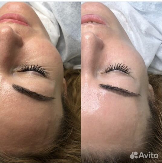 Чистка лица