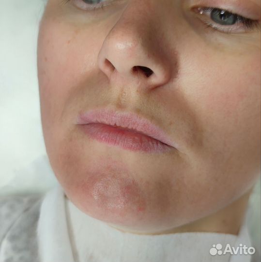 Увеличение губ