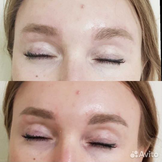 Удаление татуажа бровей лазером