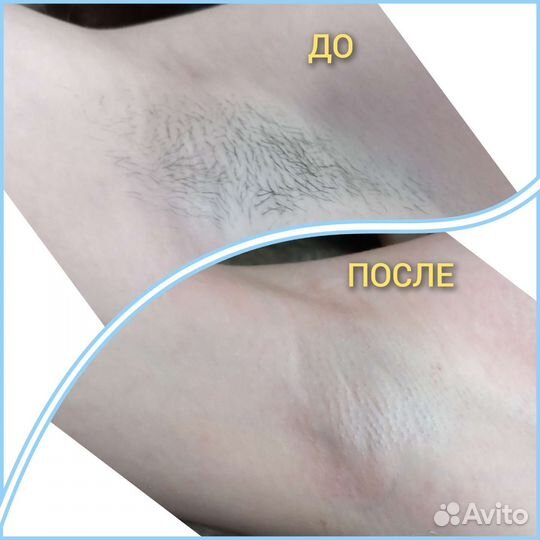 Модель на депиляцию за расходники Девушки