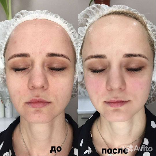 Аппарат бмс Назарова для дома