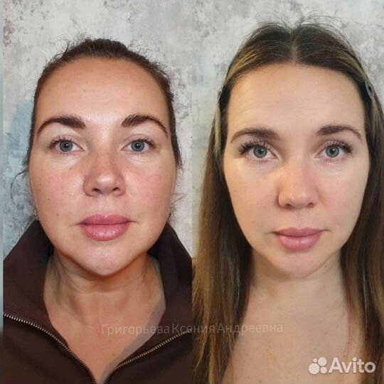 Холодная плазма. Аппаратная косметология. Акне