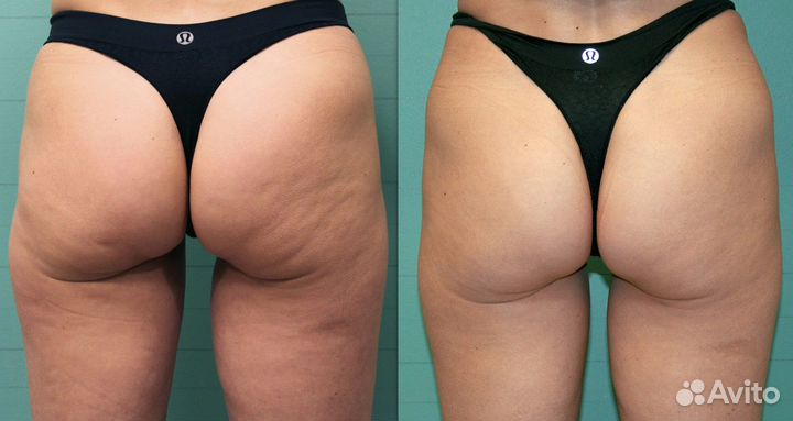 Модели на Липолазер боков