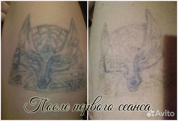 Удаление татуировок