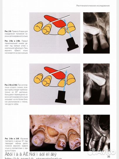 Хирургическое и ортодонтическое лечение ретинирова