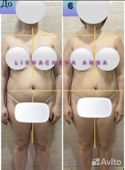 Остеопластика - мягкая правка тела и лица