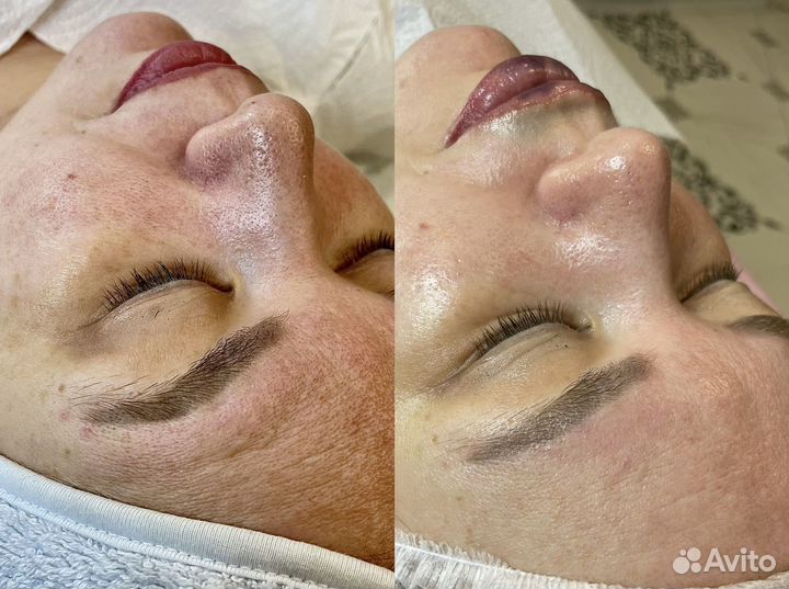 Косметолог /Чистка /Массаж/Мезотерапия Светлогорск