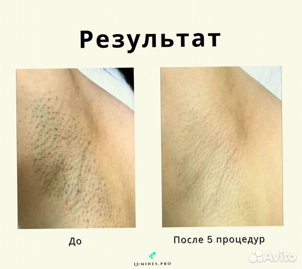 Аппарат для эпиляции «Lumines» Макс Ван 1200вт