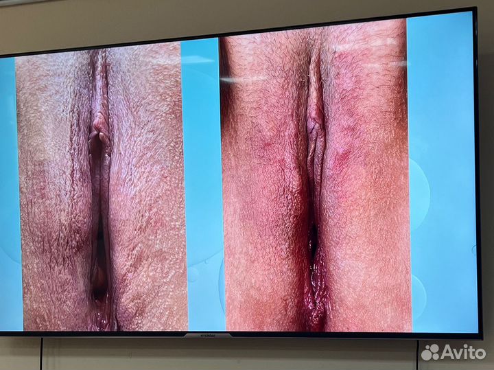 Интимное омоложение