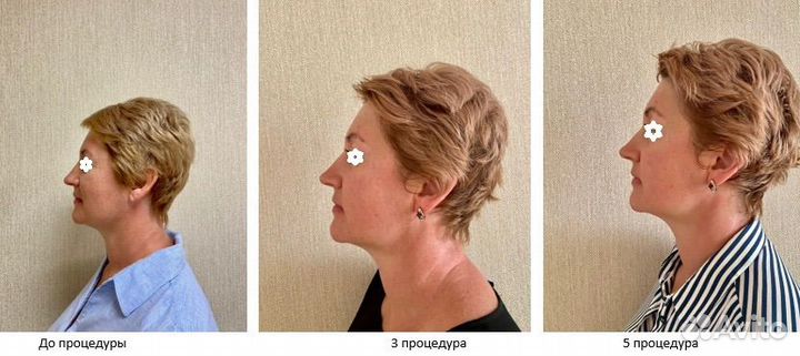 Ручная пластика лица