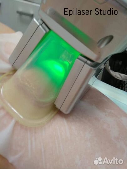 Криолиполиз -минус размер за одну процедуру