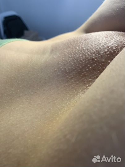 Шугаринг женский депиляция