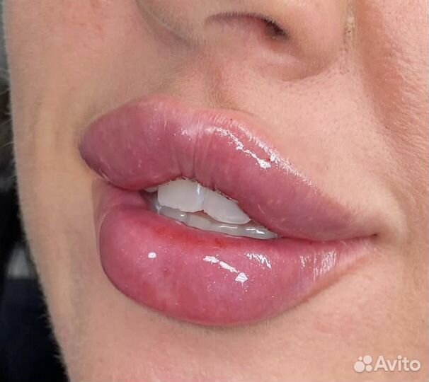 Модели на увеличение губ и контурную пластику лица