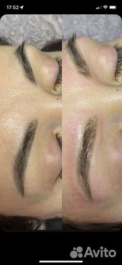 Удаление тату, татуажа, перманента