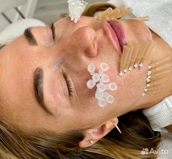 Мезонити (Тредлифтинг)