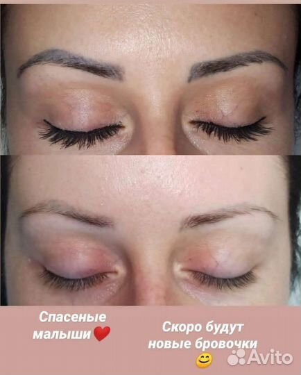 Удаление татуировок и татуажа