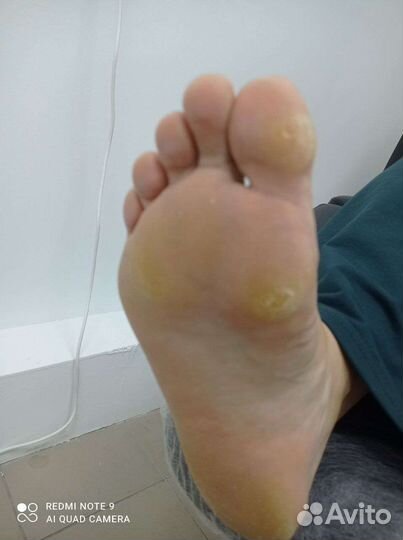 Педикюр любой сложности