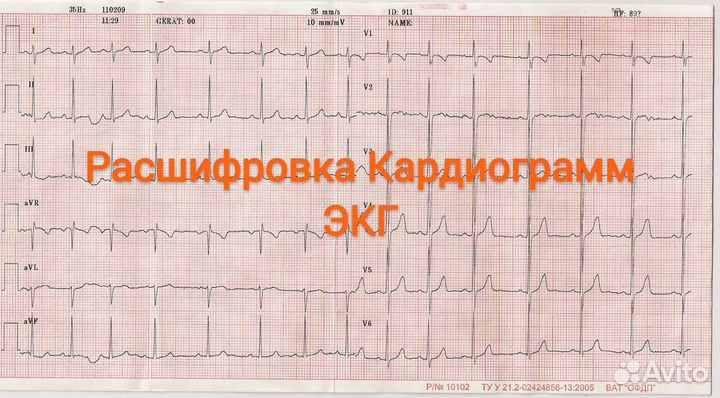 Расшифровка кардиограмм (экг)