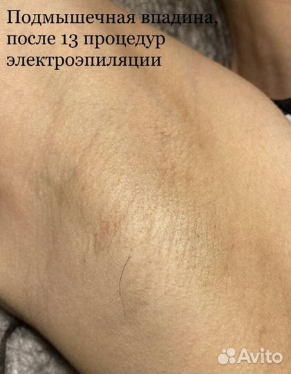 Электроэпиляция