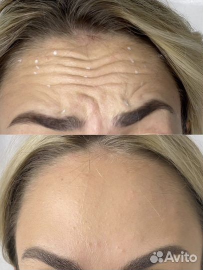 Ботокс для лица