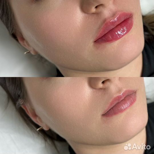 Увеличение губ/Коррекция обьема/Ботокс