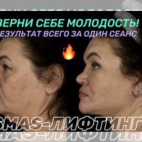 Смаслифтинг, подтяжка лица, омоложение